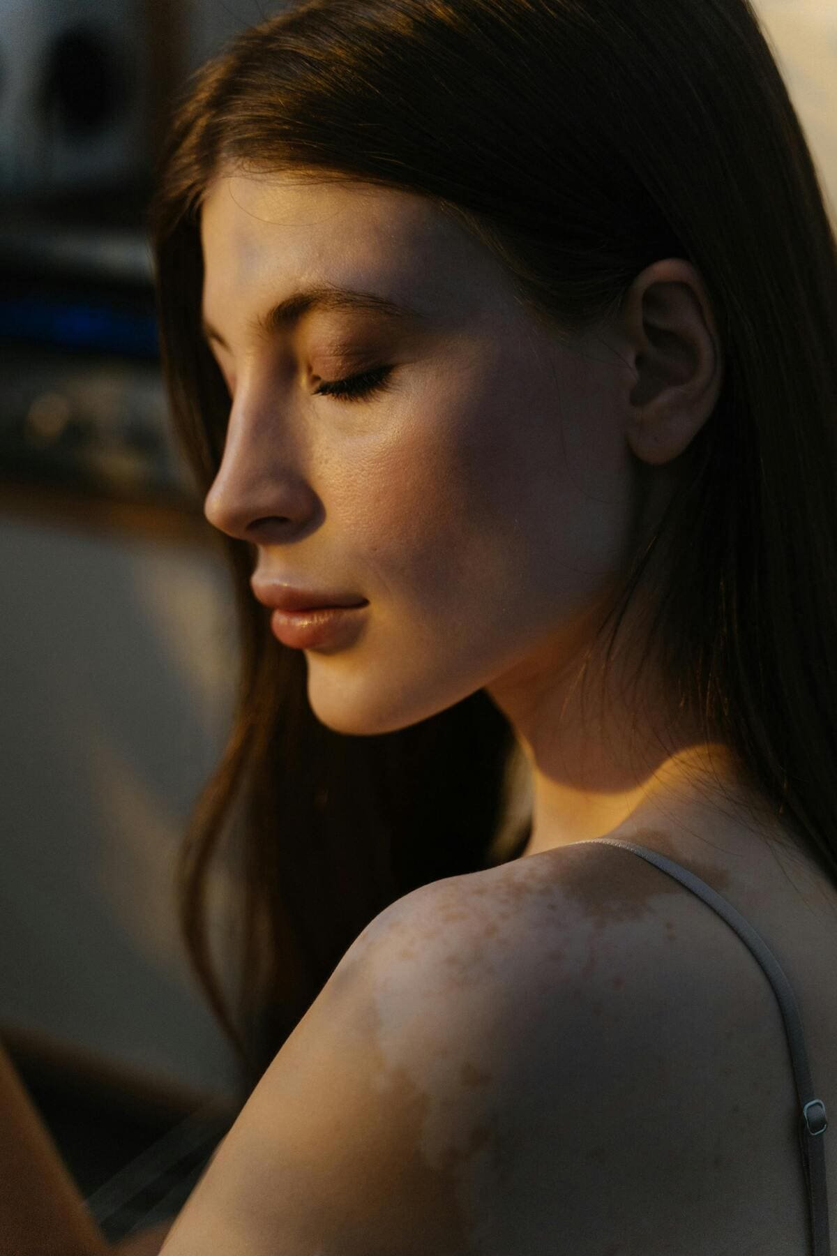 Corpo e Mente na prática - Corpo e Mente na prática - Vitiligo tem cura? Suas causas, tratamentos e novas esperanças